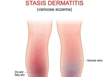 Understanding Stasis Dermatitis: Causes and Mechanisms